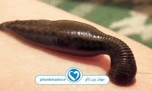 با خواص زالو درمانی چه اختلالات عصبی را می‌توان درمان کرد؟