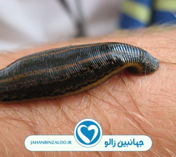 چگونه زالو بیندازیم