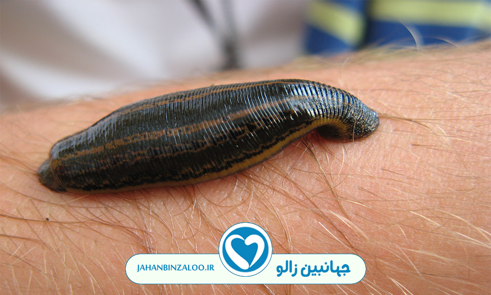 چگونه زالو بیندازیم