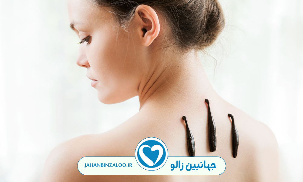 چگونه زالو بیندازیم|زالودرمانی|فروش زالو|خرید زالو|