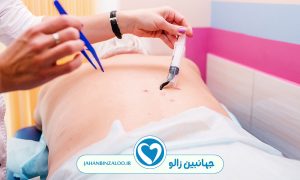 توصیه ها قبل و بعد از زالو درمانی