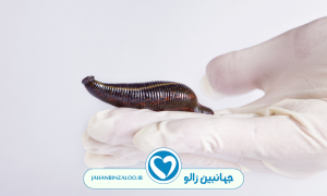 خواص زالو درمانی پشت گوش