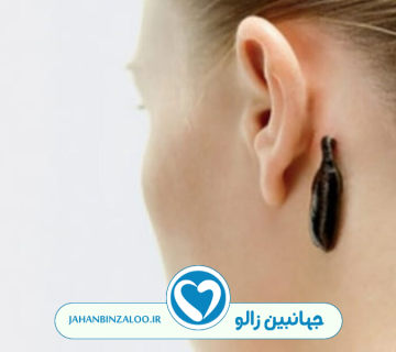 خواص زالو درمانی پشت گوش