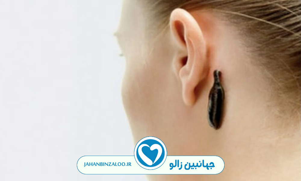 خواص زالو درمانی پشت گوش