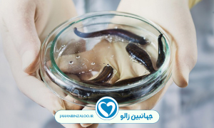خواص زالو درمانی پشت گوش