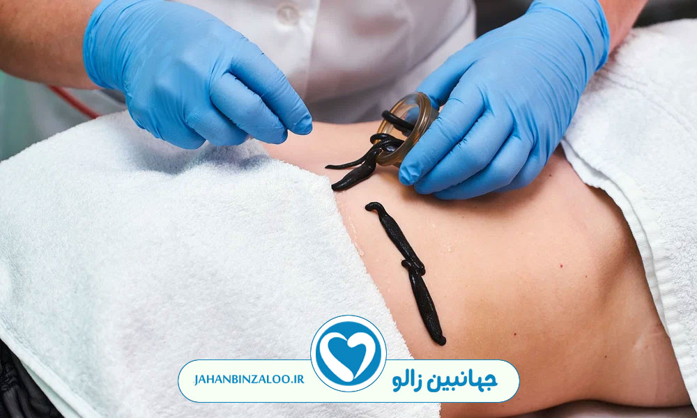 خواص زالو درمانی برای غلظت خون