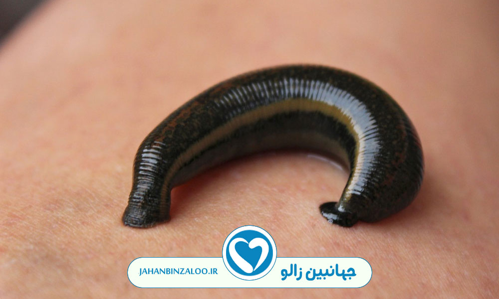 محل های انداختن زالو در زالو درمانی