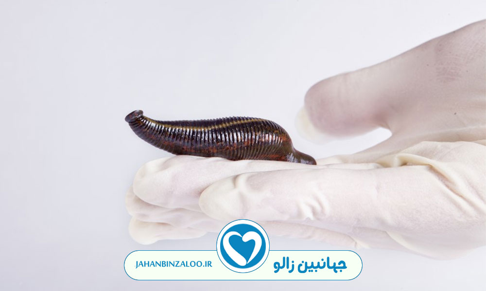 خواص شگفت انگیز زالو درمانی برای قلب