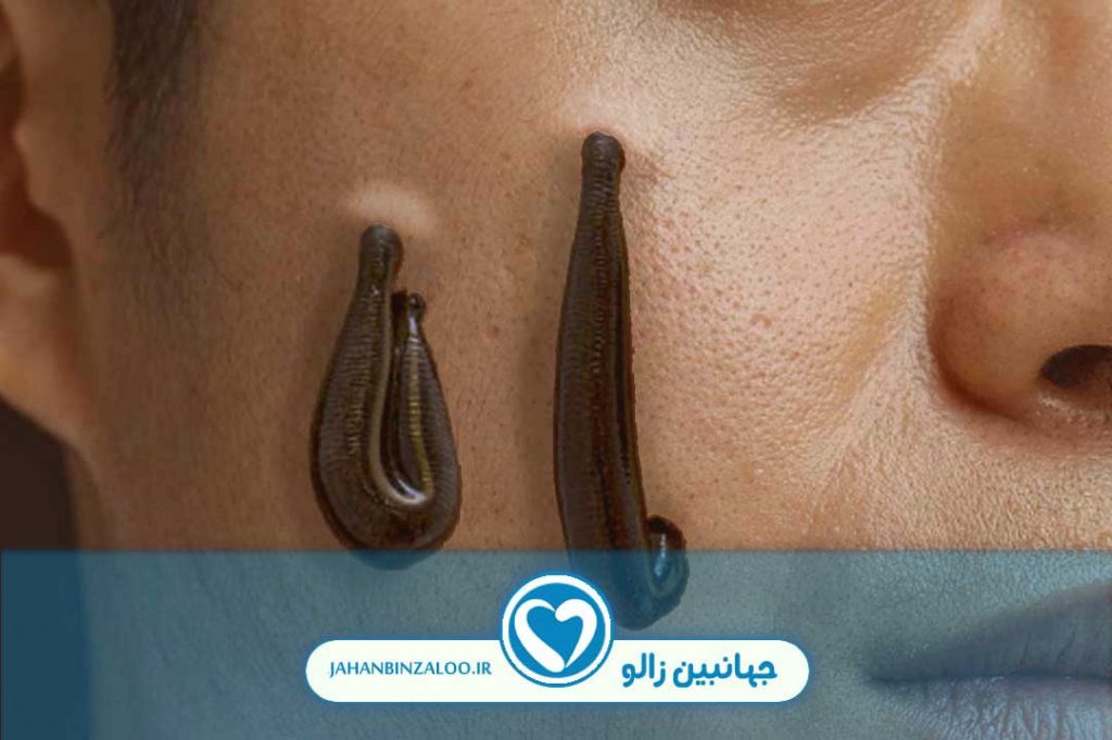زالو