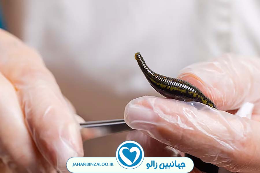 زالودرمانی|فروش زالو|خرید زالو|