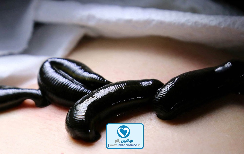 مراکز خرید زالو طبی